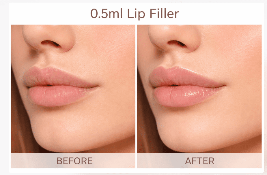0.5ml lip filler before and after showing subtle hydration and asymmetry correction.