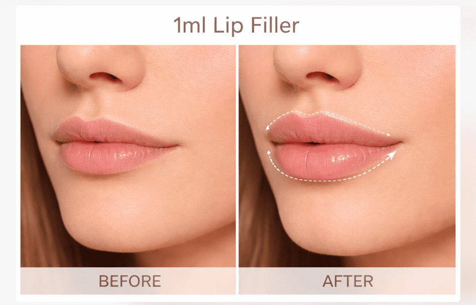 Realistic 1ml lip filler before and after on naturally thin lips showing structural support.