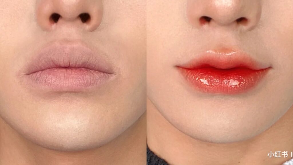 Lip Filler Shape Guide