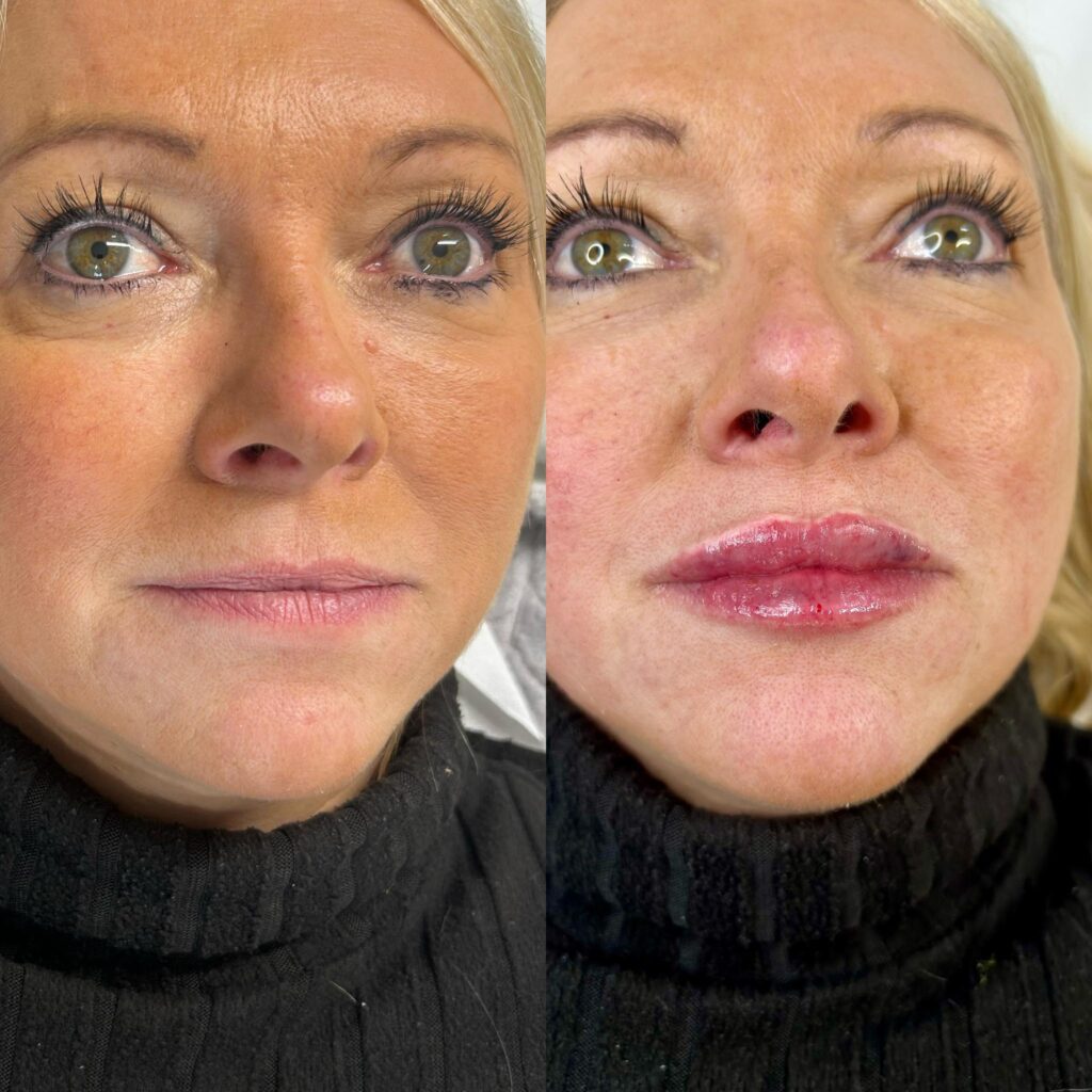 Purple Bruising After Lip Fillers