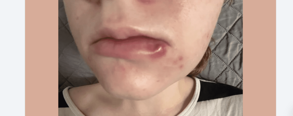 Redness and Swelling