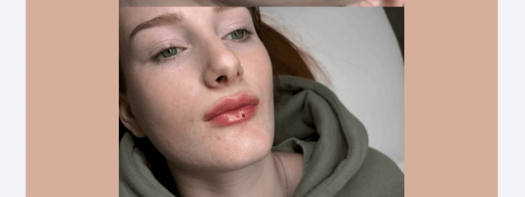 Tissue Integration & Final Assessment Window