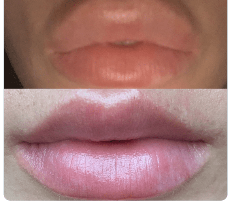 Vertical Tenting (The Pillar Technique)