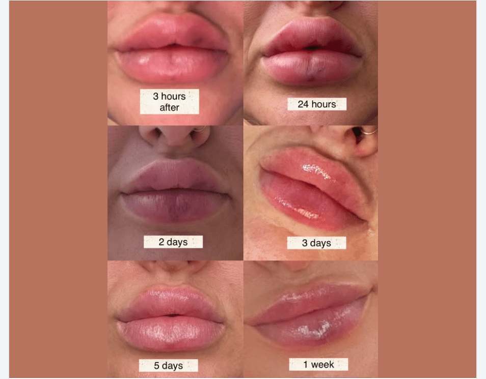 Patient showing before and after results of dissolving migrated lip filler using hyaluronidase enzyme to restore natural lip shape and remove filler mustache.