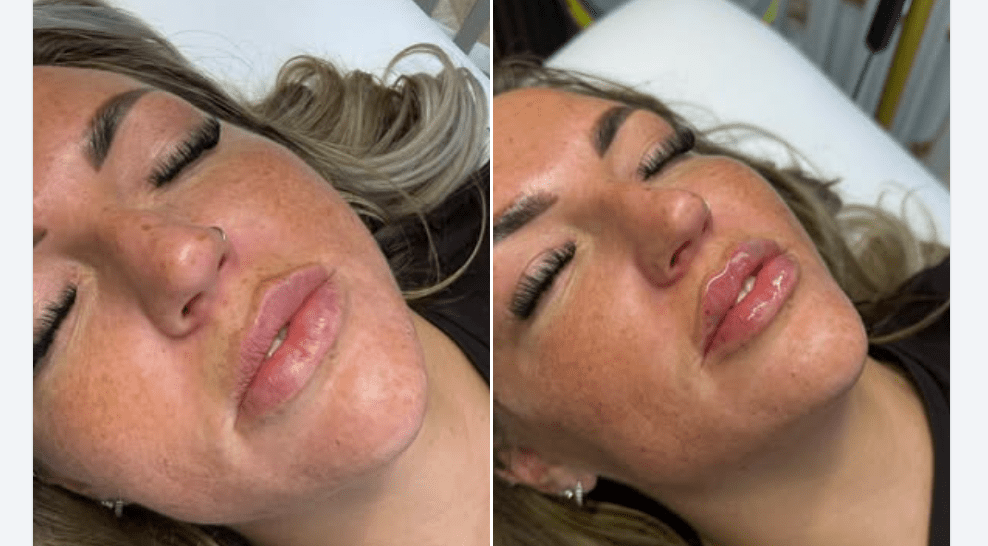 Migrated Lip Filler/Lip filler migration adjustment.