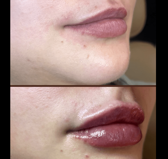 Side-by-side comparison of normal lip filler healing versus migrated lip filler showing a filler mustache and loss of the vermilion border.