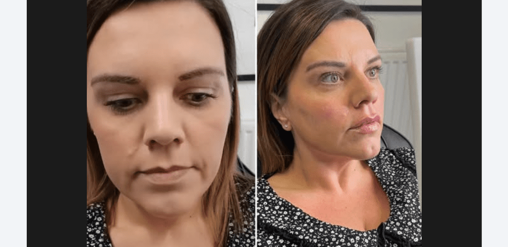 Real Patient Journeys: Versa Lip Filler Before And After