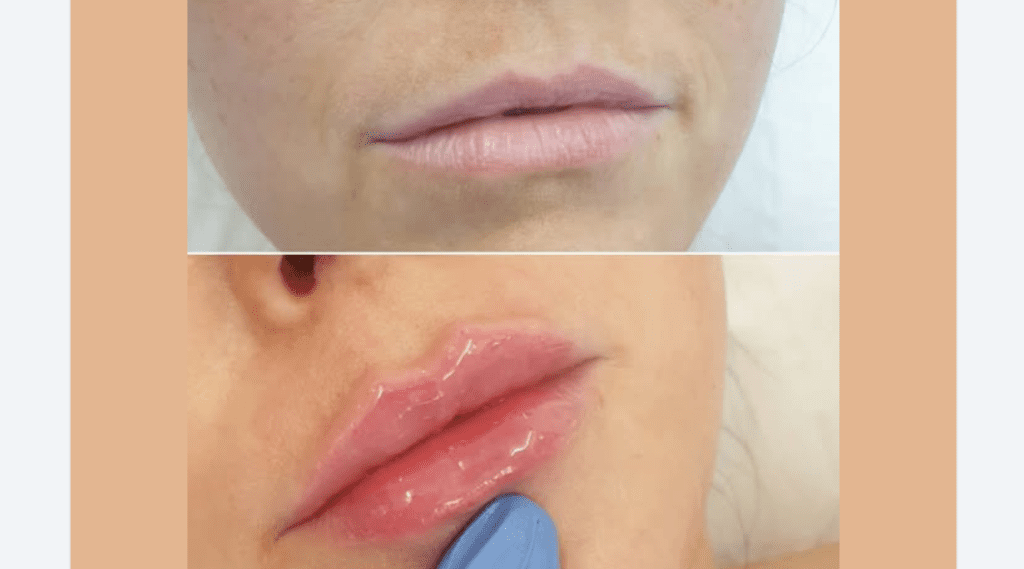 Versa lip filler Russian technique before and after 