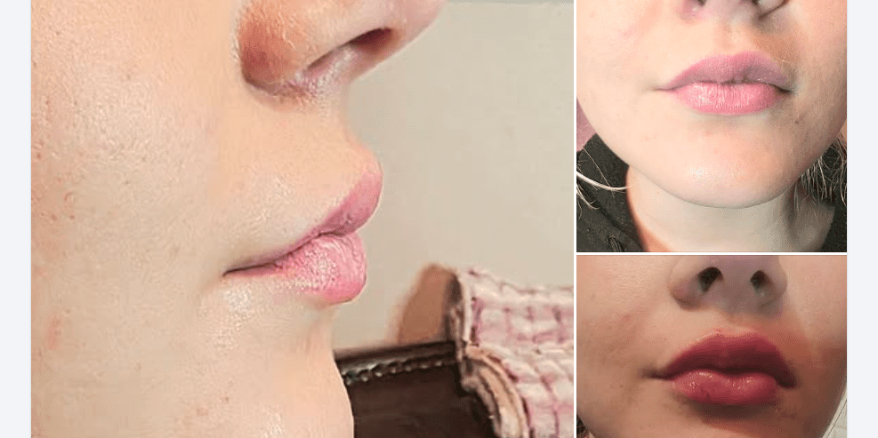 The Power Of Revanesse Versa For Natural Lip Volume