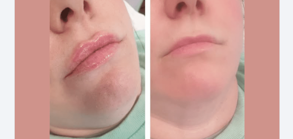 Versa Lip Filler Before And After