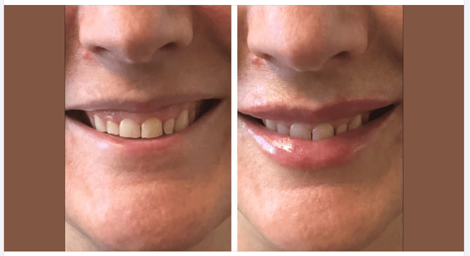 Volbella for Aging Lips