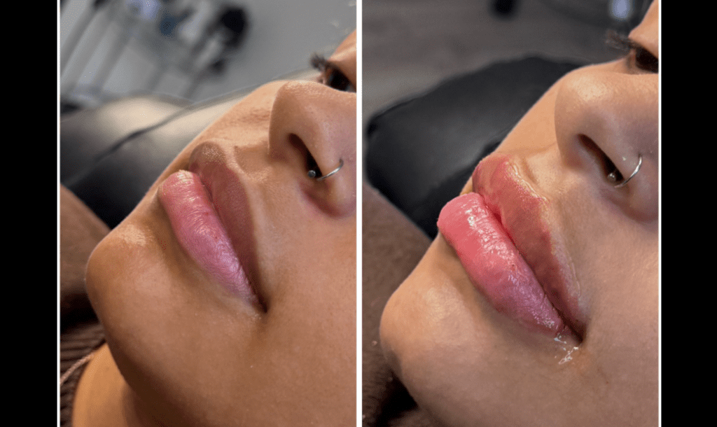 Volbella for Asymmetric Lips