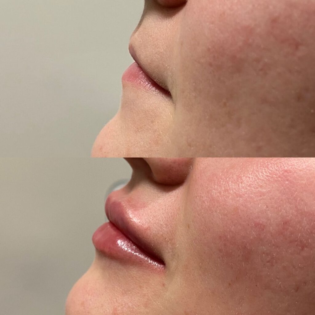 half syringe 0.5ml lip filler before and after subtle natural results 2026