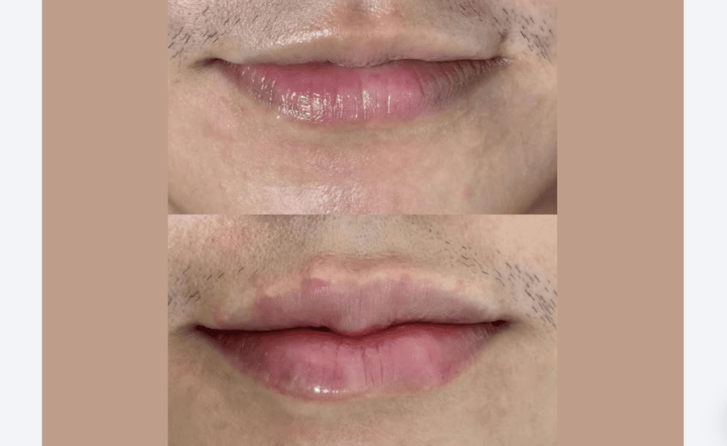 Moustache Shadowing on Lips