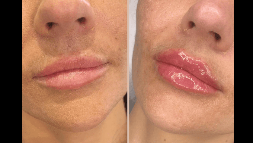 Subtle Upper Lip Lift Results