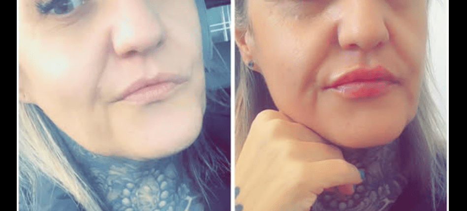 Thin Lips Transformation