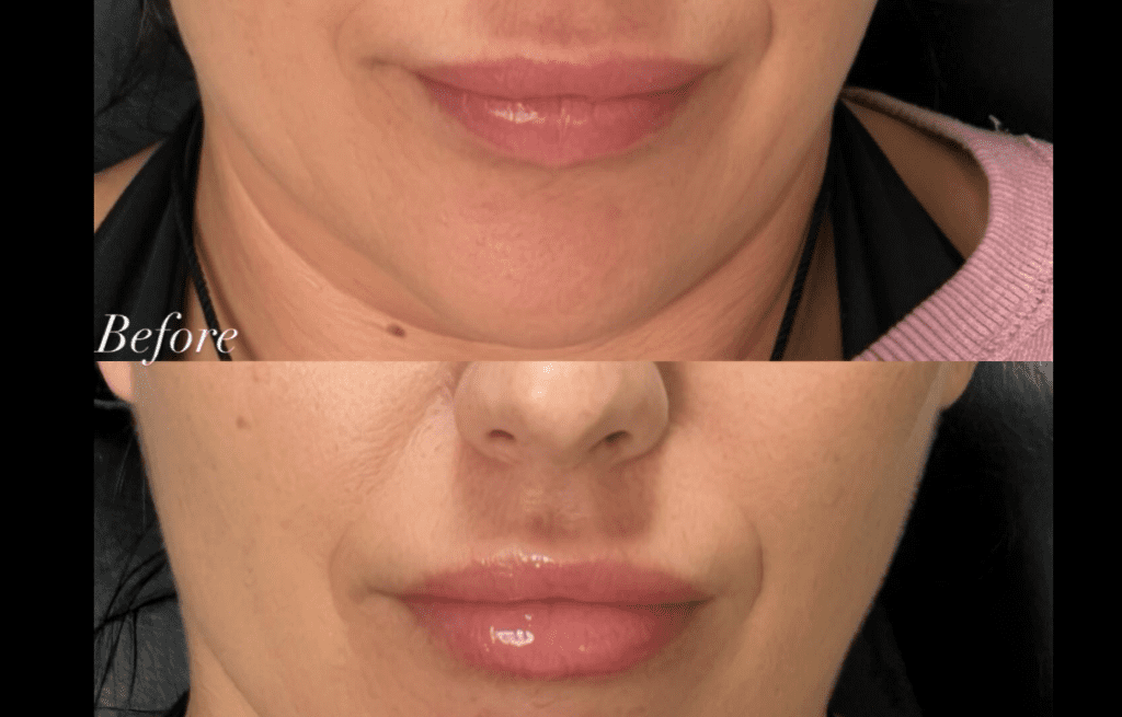 Natural Lip Enhancement Results