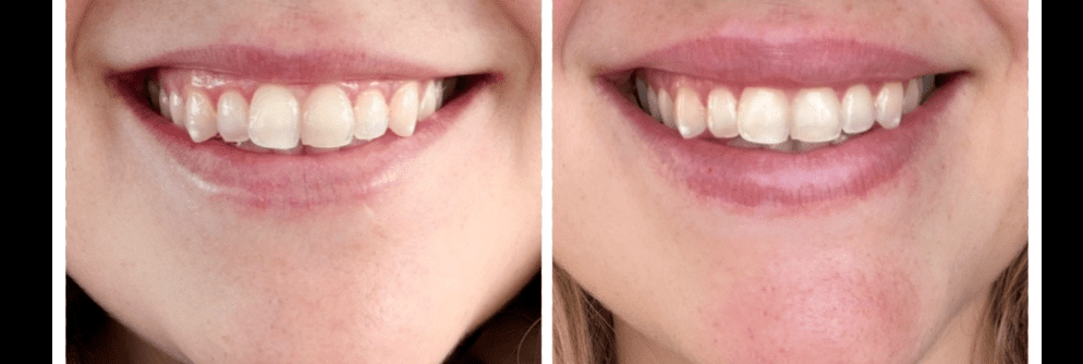 Upper Lip Lift Changes