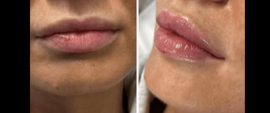 Smile Transformation Results