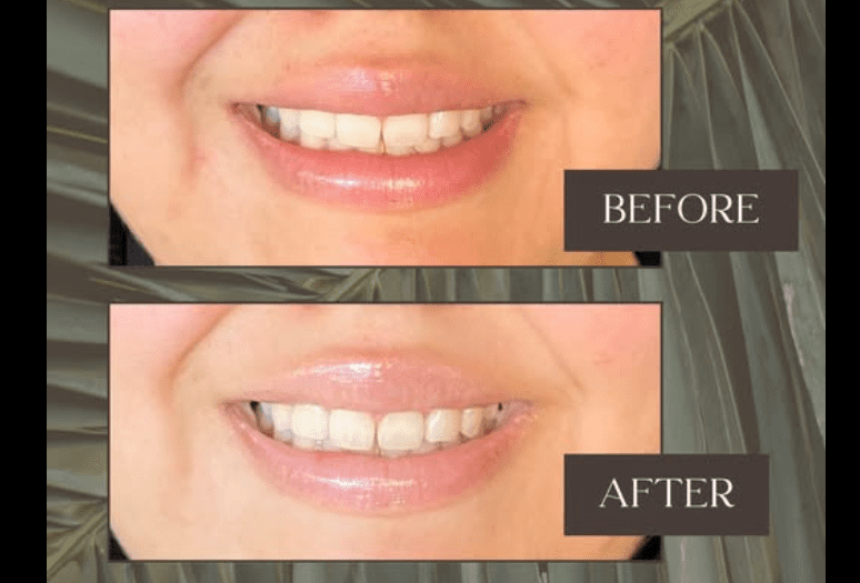 Results for People With Gummy Smile