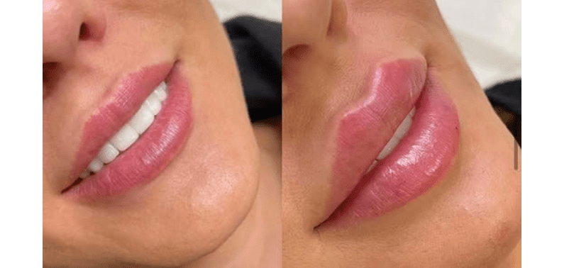 Natural Lip Filler Results
