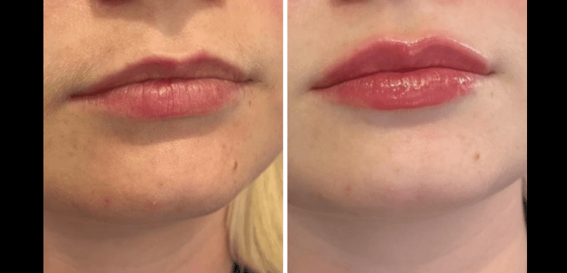 Volume Enhancement Results