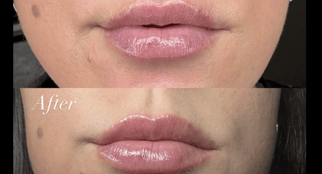 Lip Shape and Contour Improvement