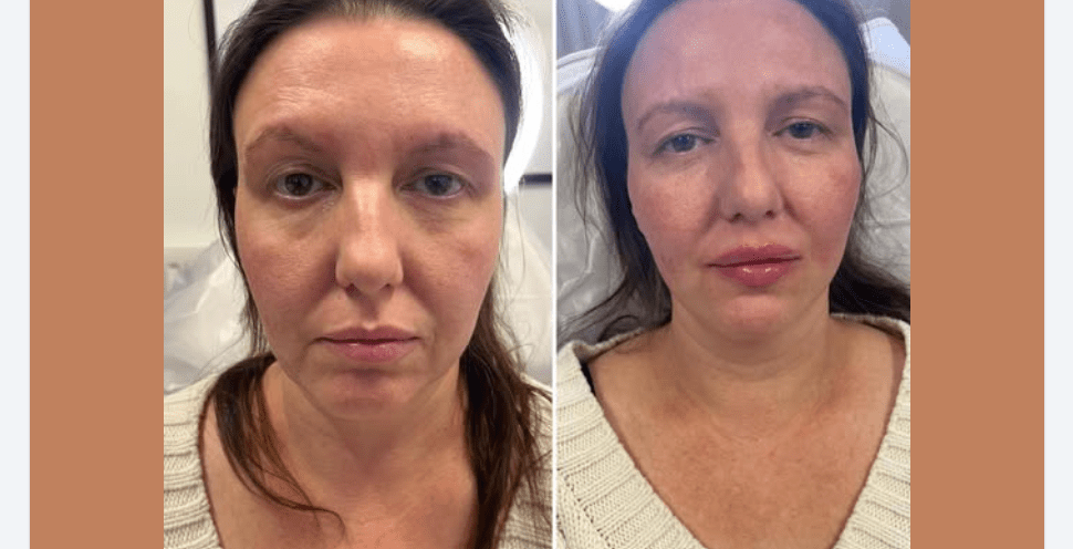 Half Syringe Lip Filler Before and After