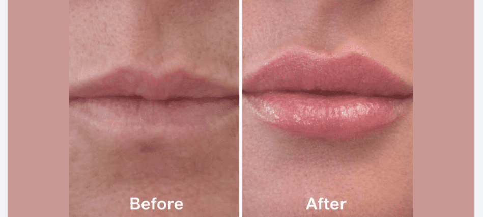 Half Syringe Lip Filler Before and After on Thin Lips