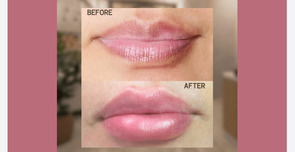 Half Syringe Lip Filler Before and After with Botox: The Combination Effect