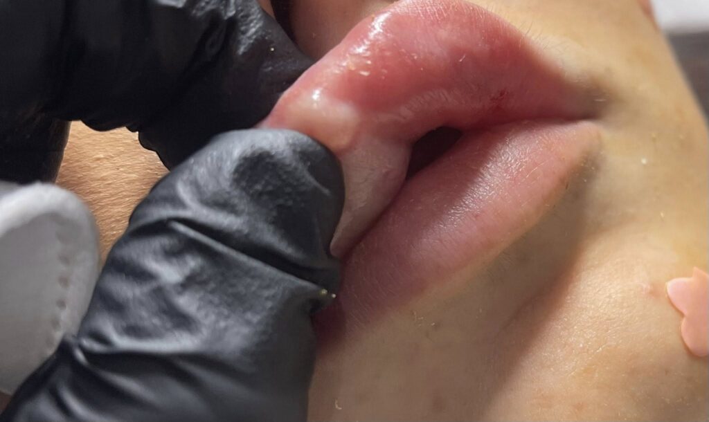 Doctor examining normal lumps in lips after filler treatment in the submucosal plane to rule out vascular occlusion.