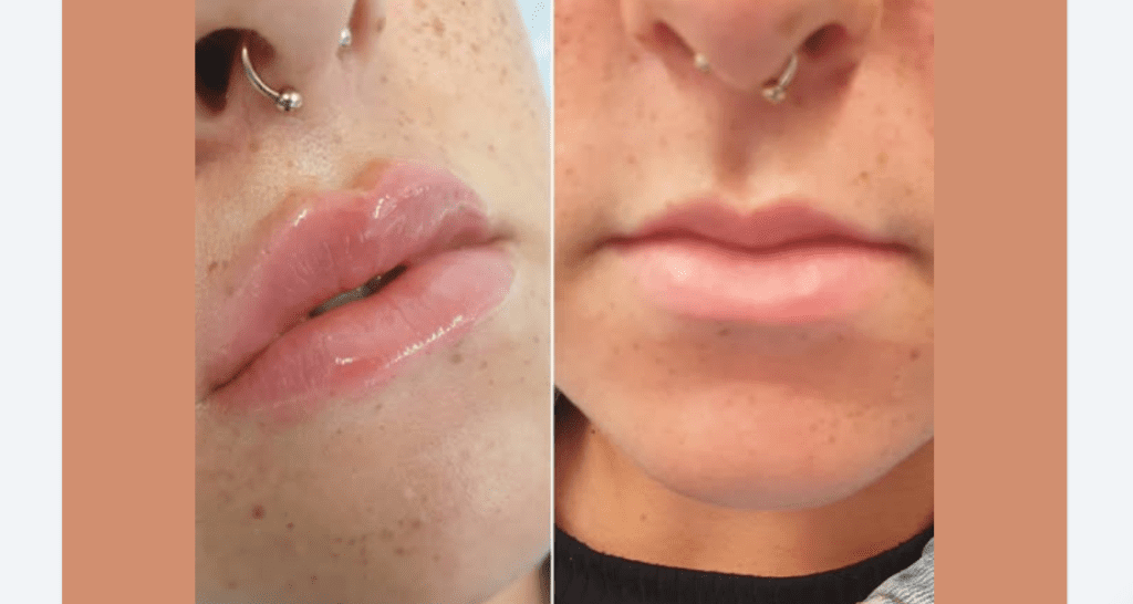 realistic 1ml lip filler before and after thin lips result