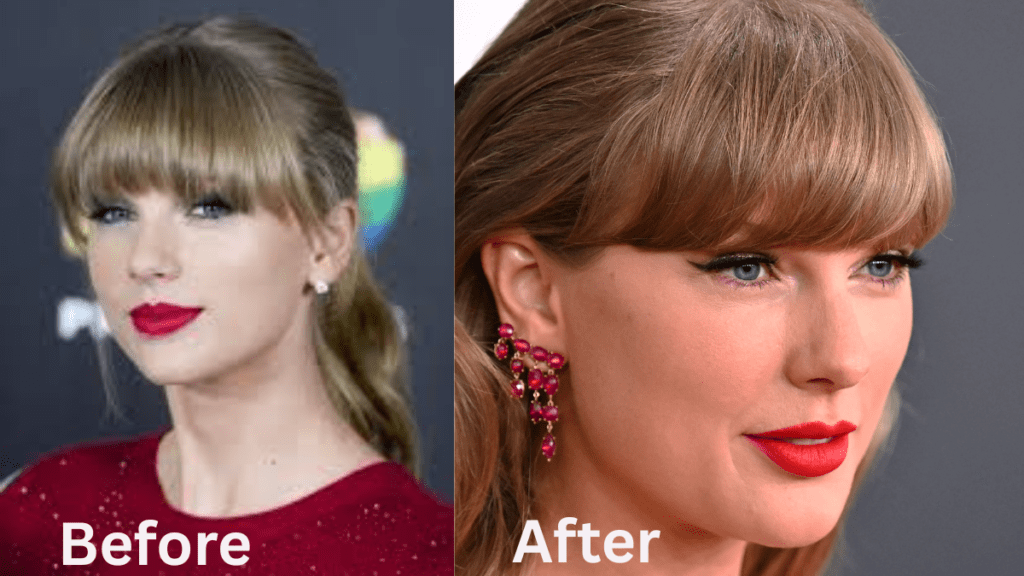Taylor Swift Lip Filler (2026 Update): Did She Get Fillers?
