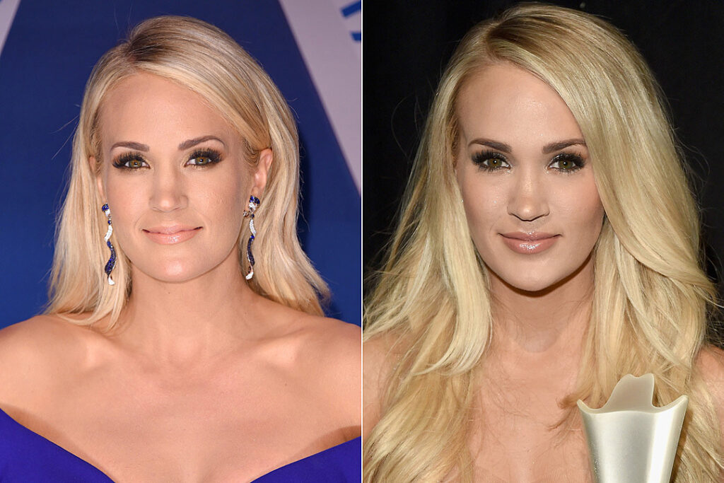Carrie Underwood Lip Filler Shock