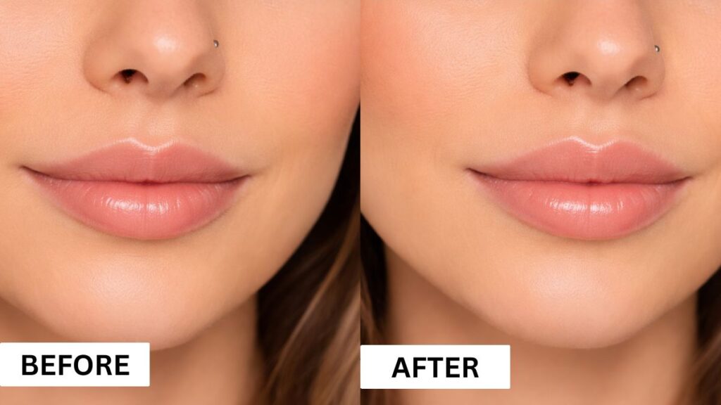 How Much Is Lip Filler In Maryland