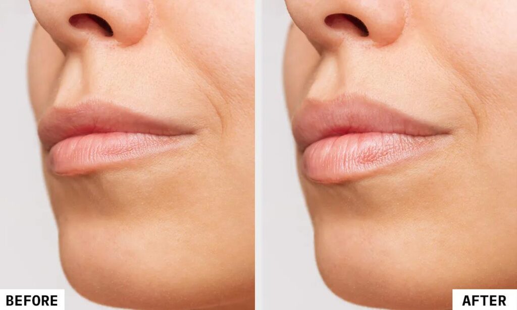 How Much Is Lip Filler In Minnesota