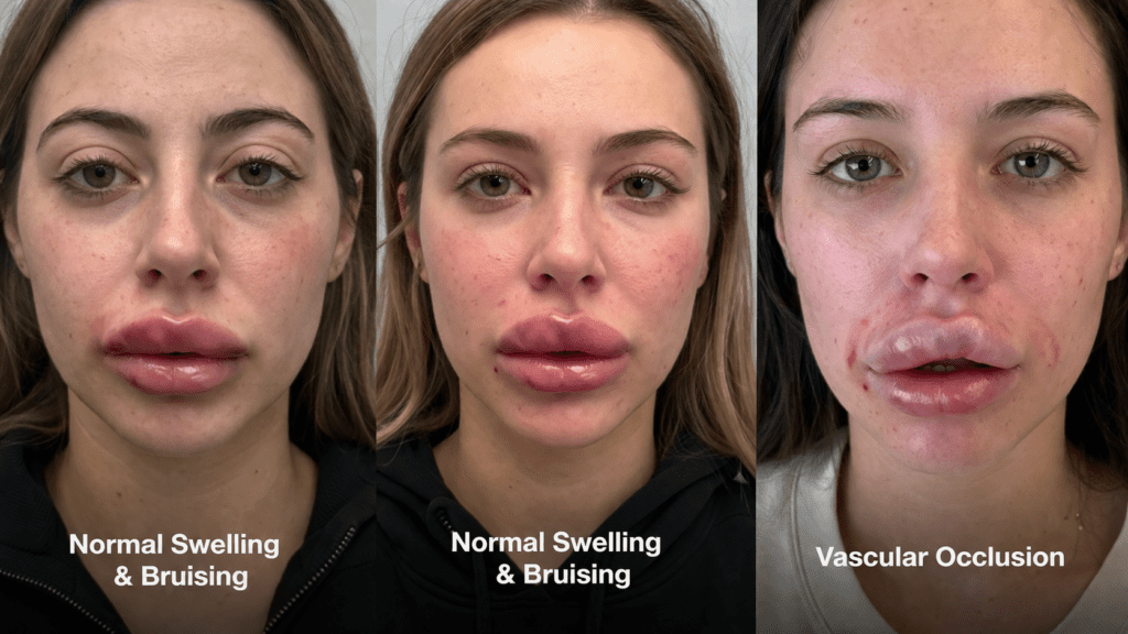 Normal Swelling & Bruising vs. Vascular Occlusion