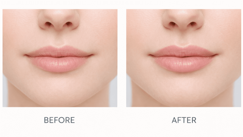 What Affects Lip Filler Cost in Las Vegas or Results Expectation