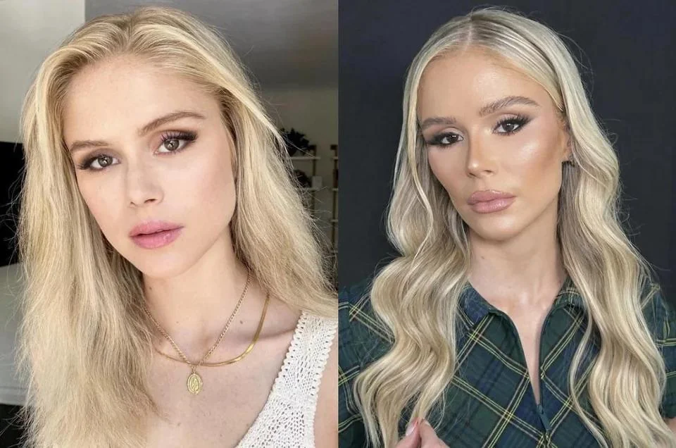 Erin Moriarty Lip Filler 2026 Update