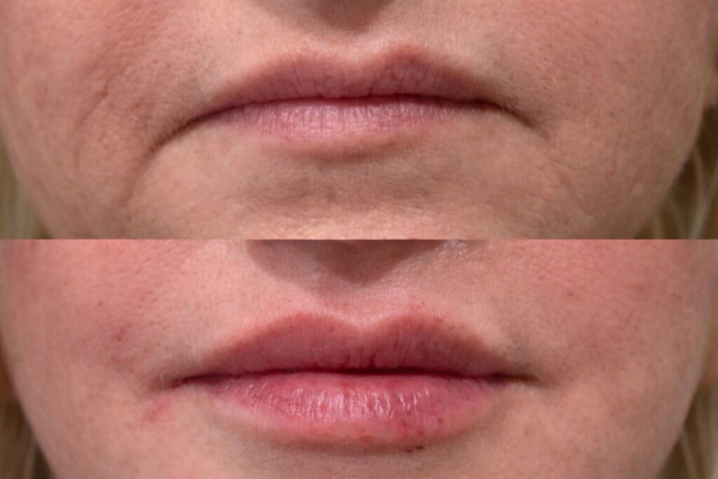 risks of cheap lip fillers Minnesota safety guide