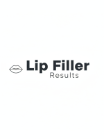 Lip filler results